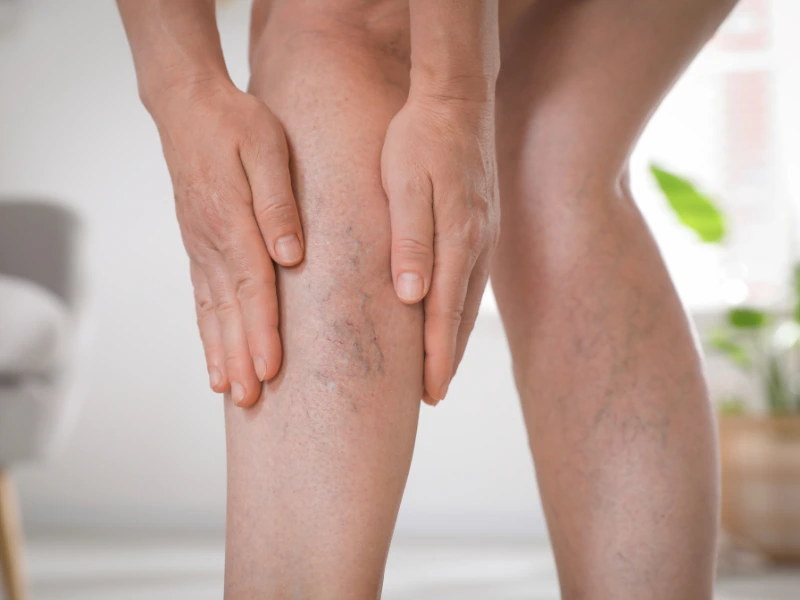 spider vein injection​