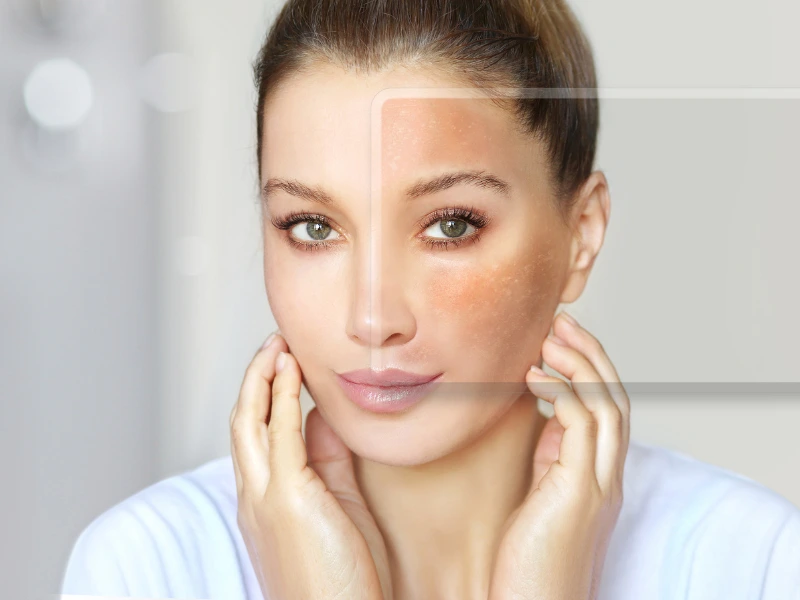Glace treatment