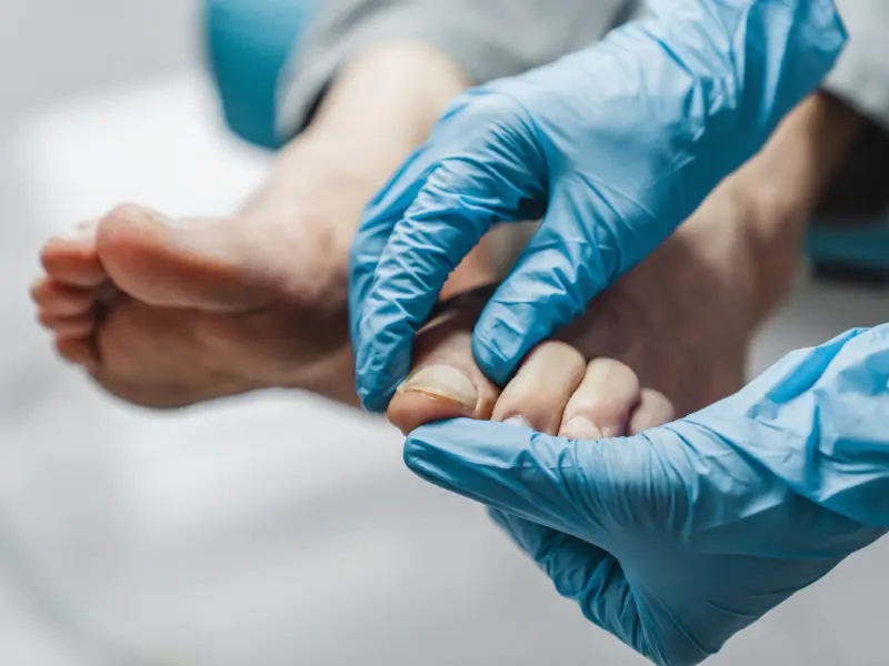 before and after fungal nail laser treatment