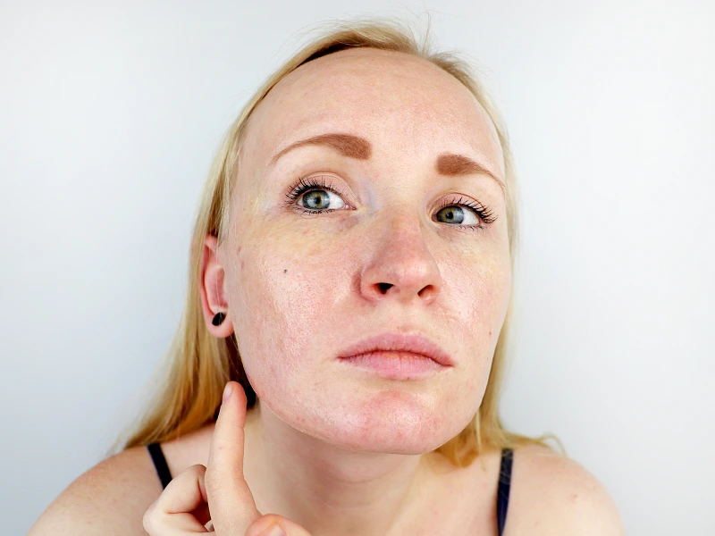 fractional co2 skin resurfacing