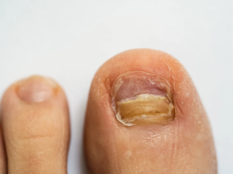 laser fungal nail treatment review