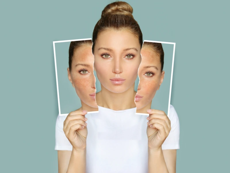 laser resurfacing before and after