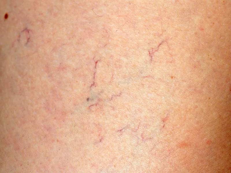 sclerotherapy benefit