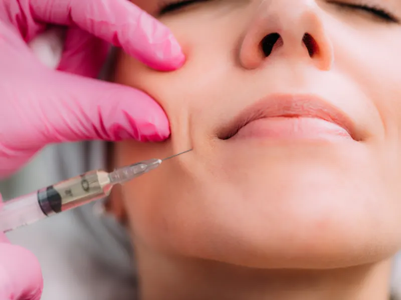 smile line fillers before and after