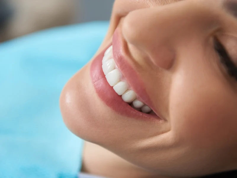 smile line fillers in redondo beach