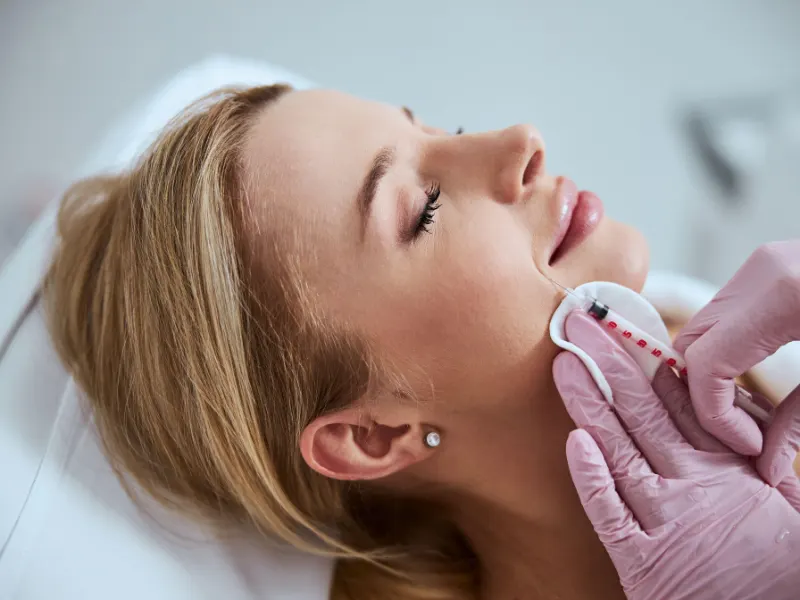 smile line fillers results