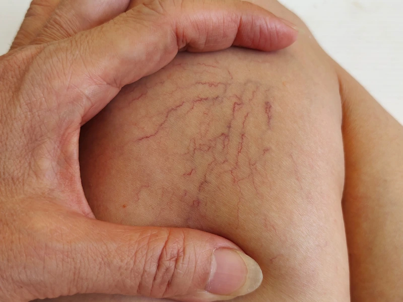 spider veins treatment in redondo beach