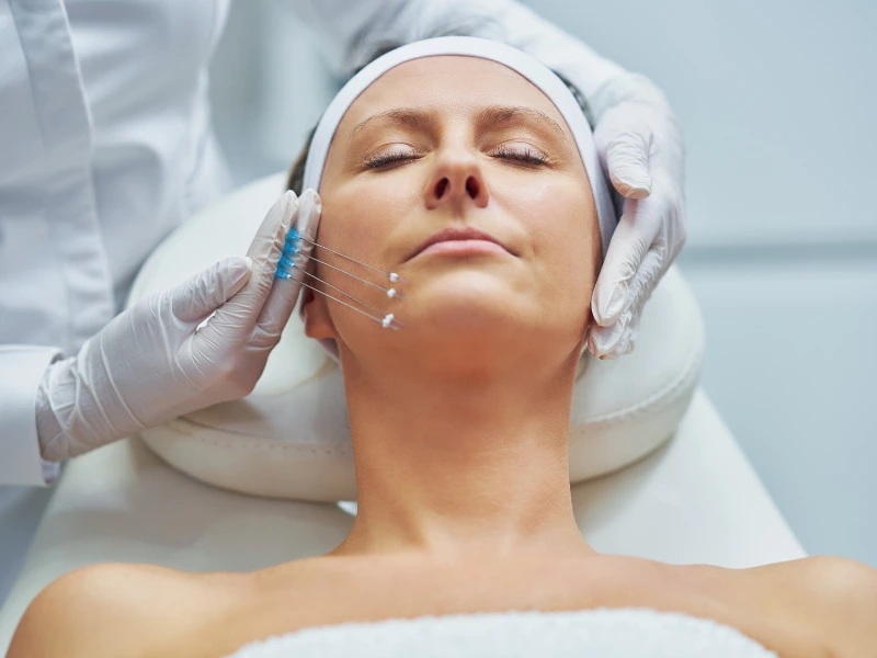 treatment areas of pdo thread lift