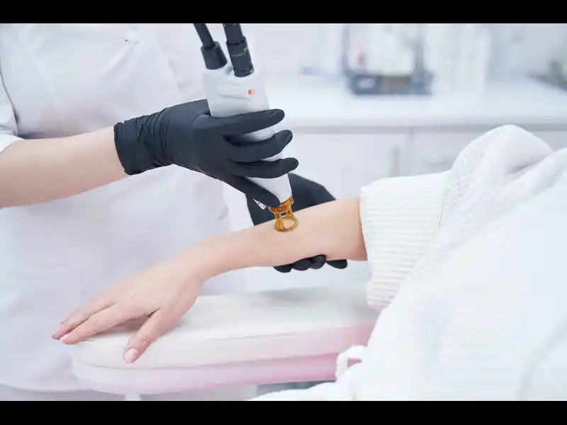 what is laser hair removal