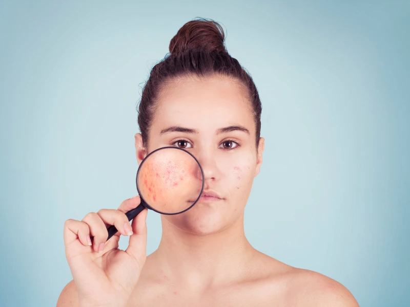 Acne Program