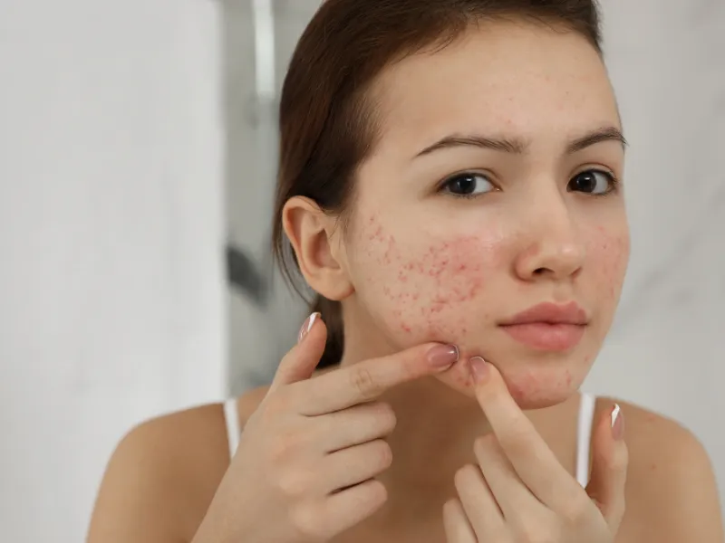 Acne Program