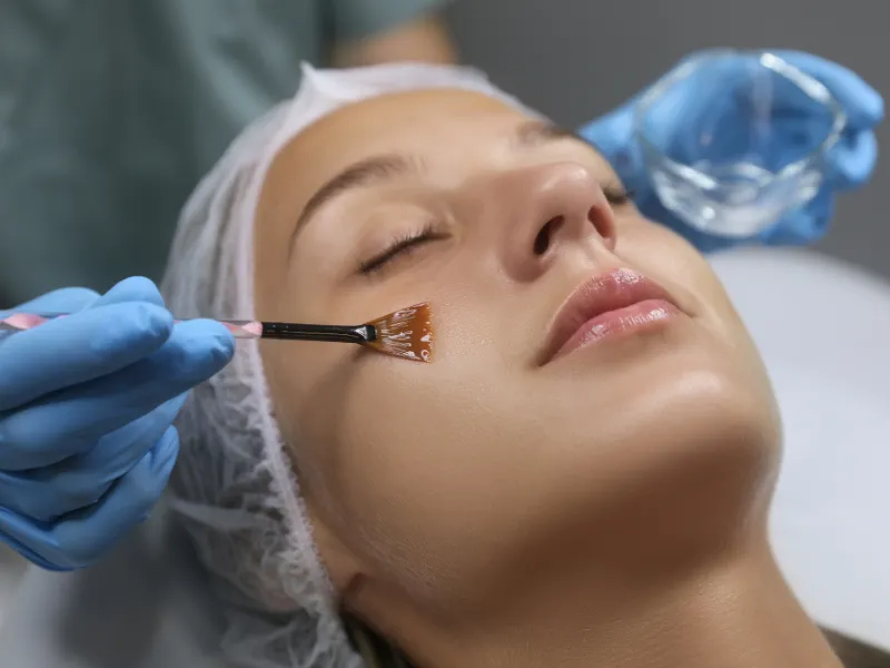 chemical peels in redondo beach california