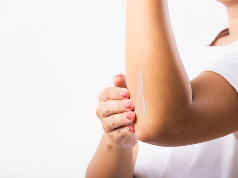 Elbow Bleaching