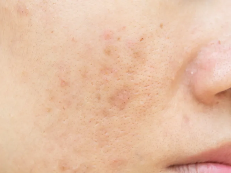 Fractional Co2 Skin Resurfacing