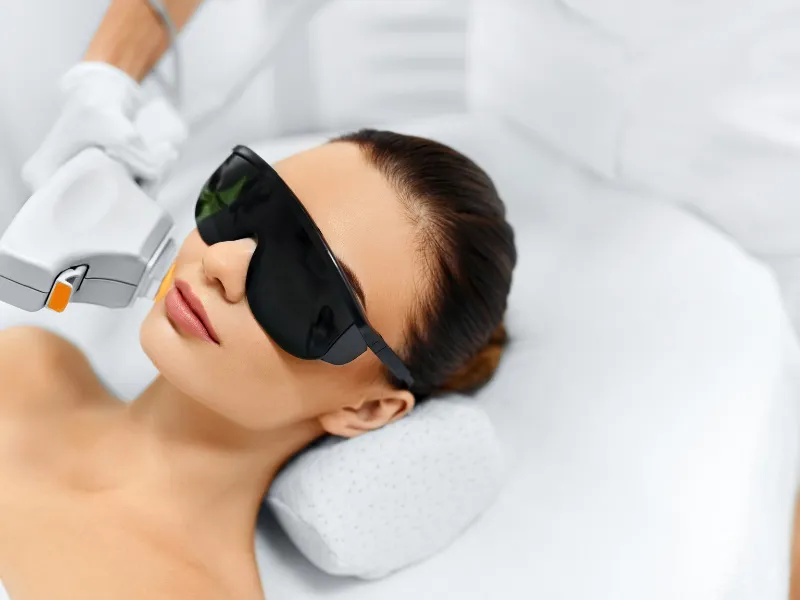 Ipl Photorejuvenation Photofacial