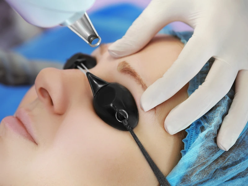 Laser Eyebrow Tattoo Removal