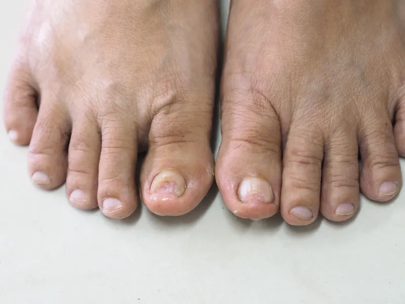 Laser Fungal Nail Removal