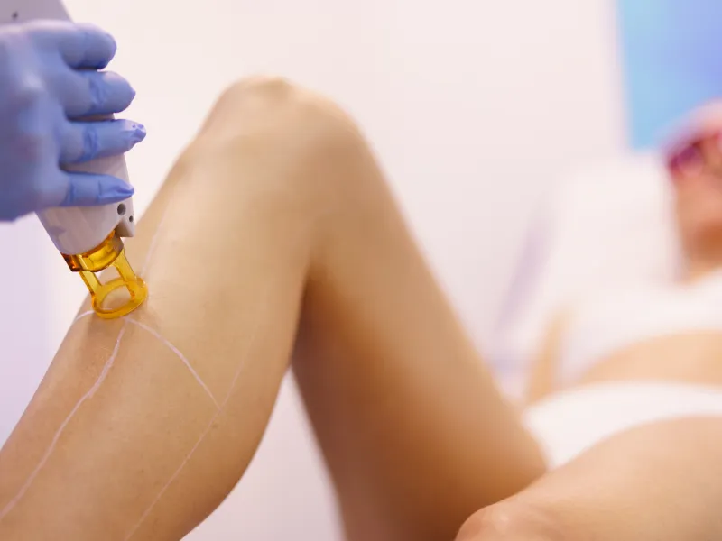 Laser Hair Removal: Legs