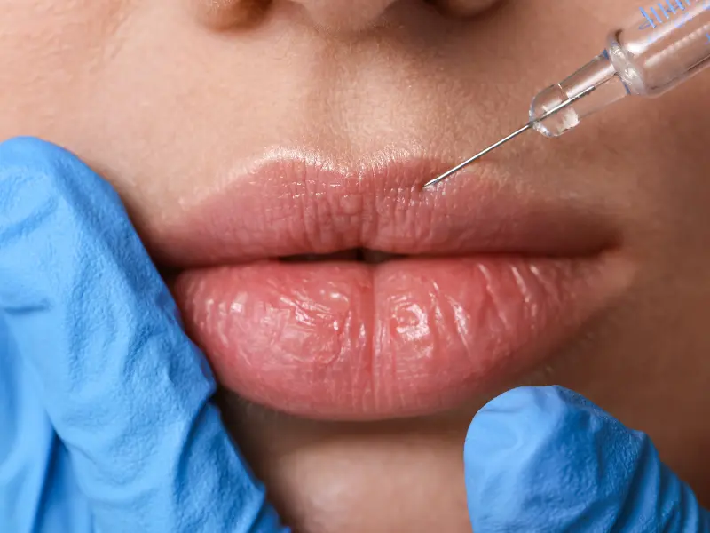 Lip Fillers
