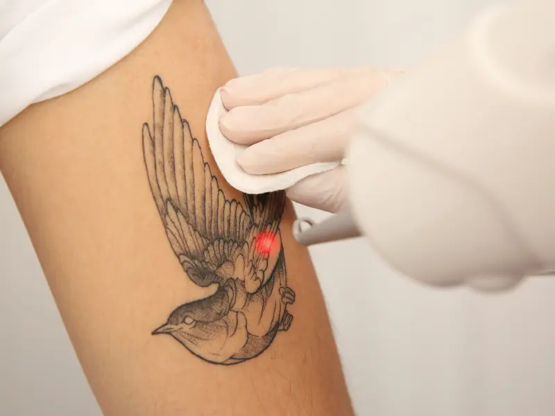 Picoway Laser Tattoo Removal