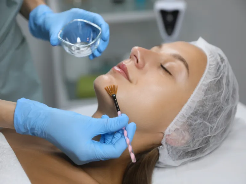 procedure of chemical peels
