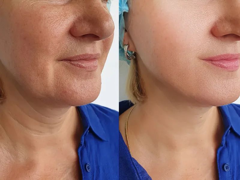 Profound Matrix Microneedling