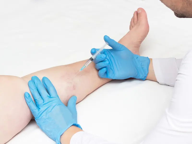 Sclerotherapy