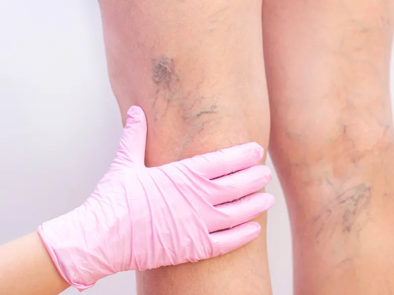 Sclerotherapy