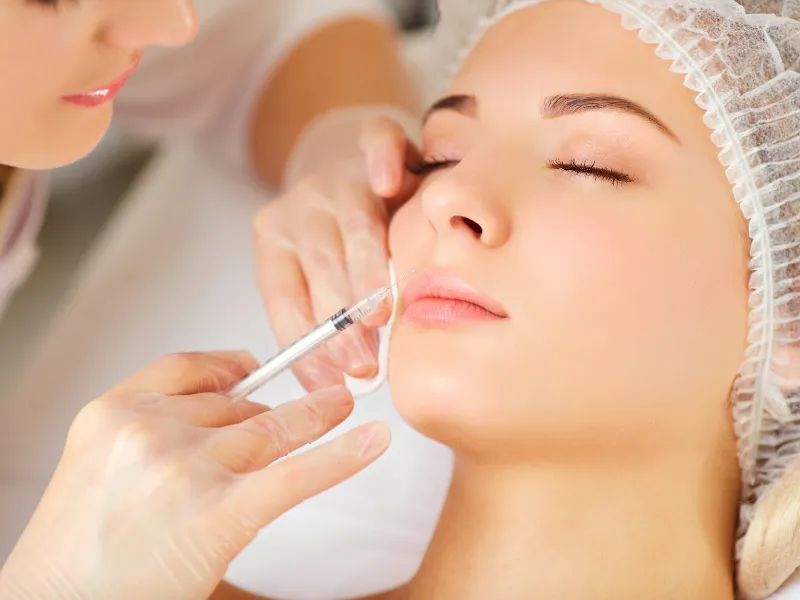 Smile Line Fillers