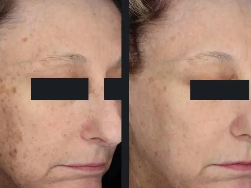 before after ipl laser treatment