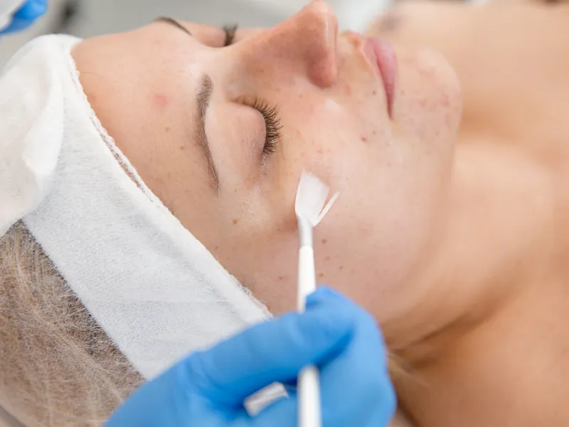 good candidates chemical peel