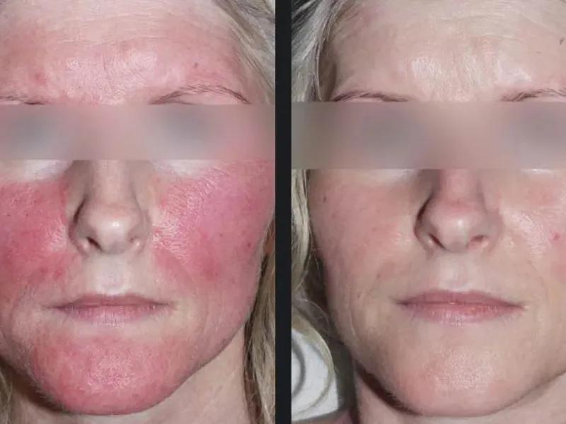ipl laser before and after