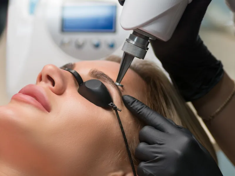 laser eyebrow tattoo removal redondo beach