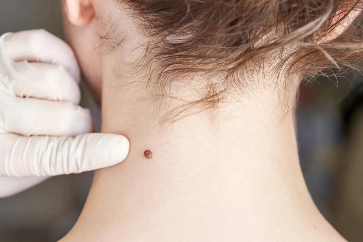 laser skin tag removal