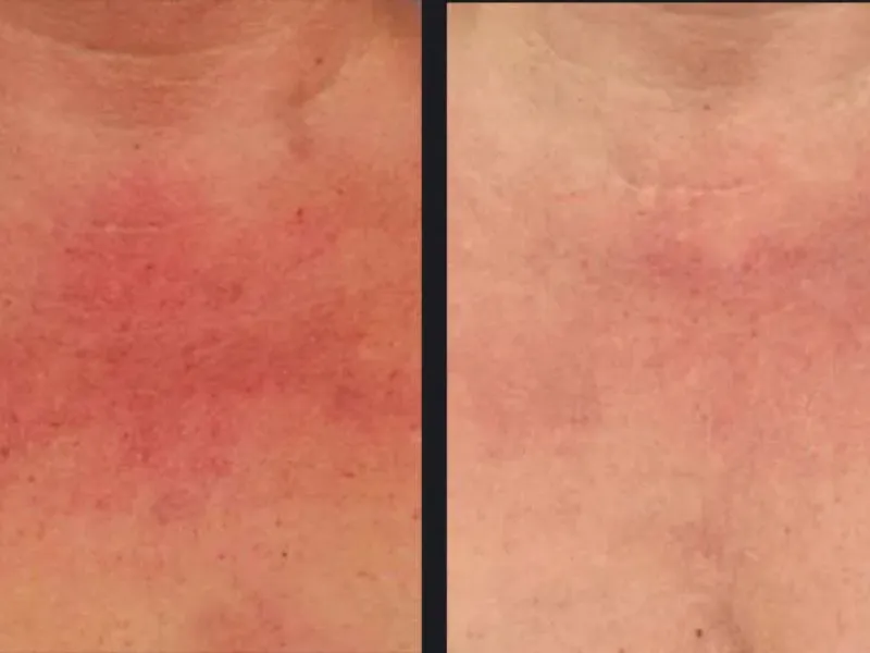 nordlys ipl laser before and after