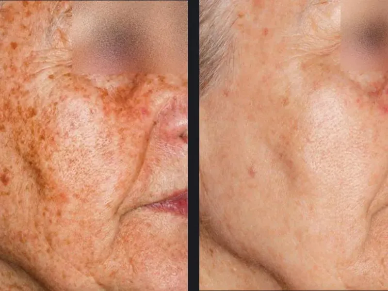 pl laser before and after treatment
