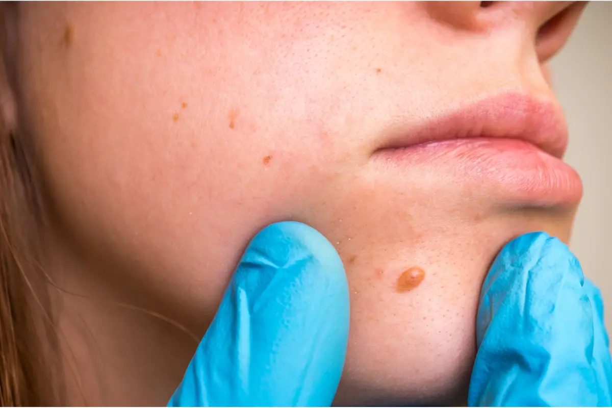 skin tag removal