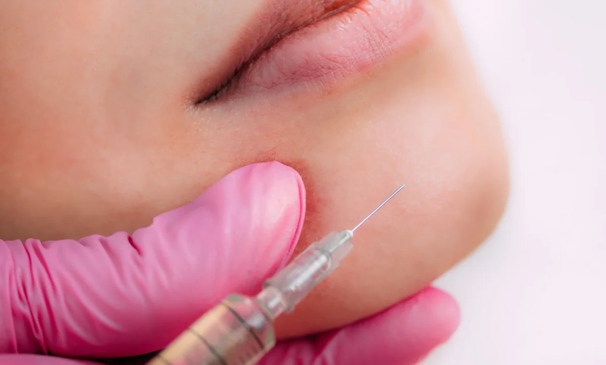 how long does chin filler last