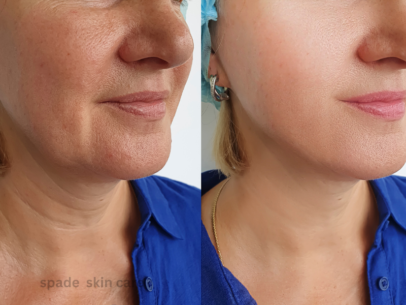 before and after jawline filler